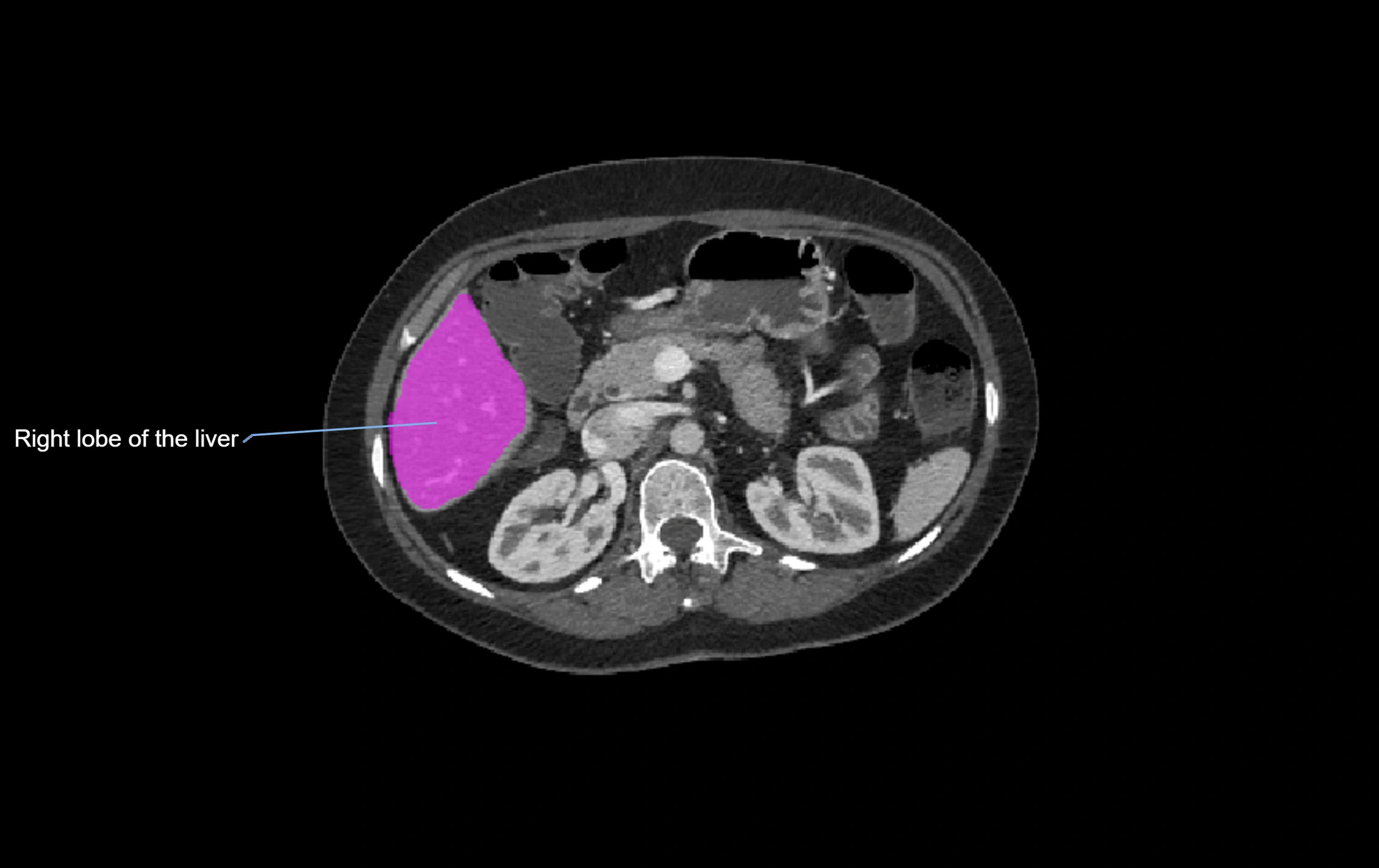CT lliver lobes axial cross sectional anatomy labelled image -00031.webp